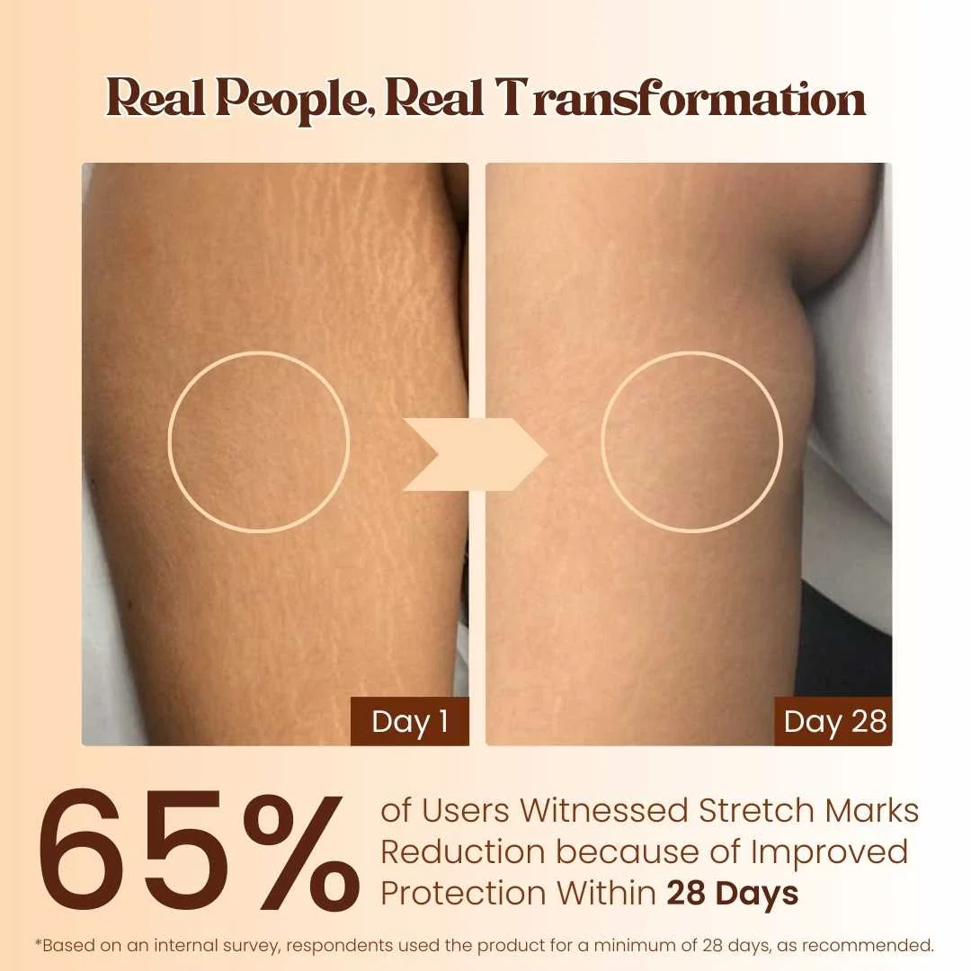 Stretch Mark Cream