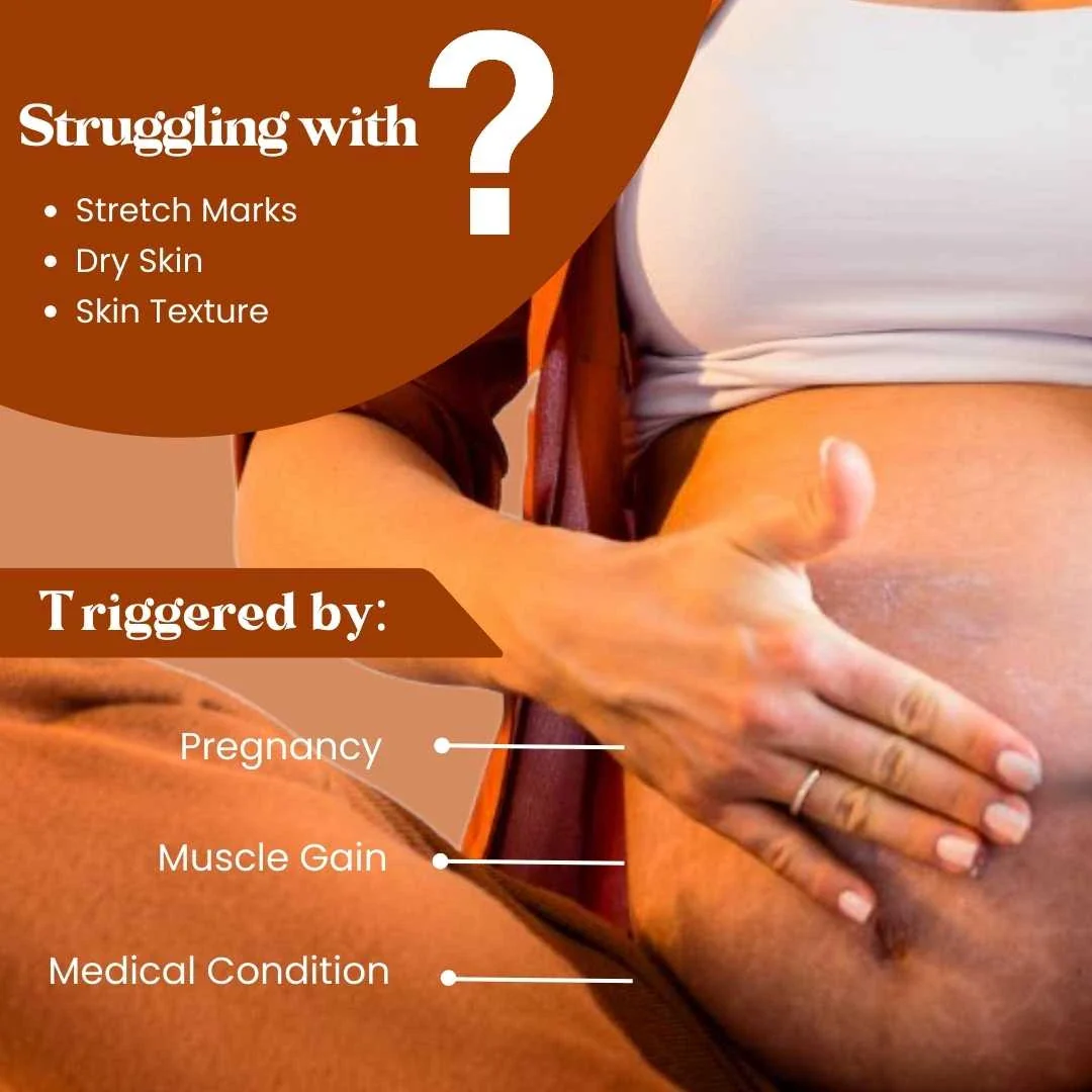 Stretch Mark Cream